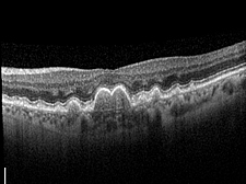 Angiographie bei gesunder Makula