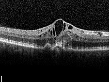 Angiographie bei feuchter Makuladegeneration (Gef&auml;&szlig;neubildung in der Makula)