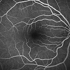 Angiographie bei gesunder Makula