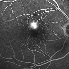 Angiographie bei feuchter Makuladegeneration (Gefäßneubildung in der Makula)