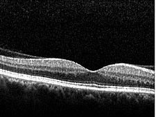 OCT-Bild einer normalen Makula (Stelle des schärfsten Sehens der Netzhaut) mit typischer zentraler Einsenkung (Fovea)