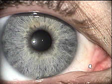 Foto des vorderen Augenabschnittes