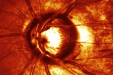 Fotografie des Sehnervenkopfes mit einer zentralen Aushöhlung des Nerven bei einem Patienten mit Glaukom