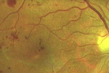 Vom Patienten nicht bemerkbare Blutungen bei diabetischer Stoffwechsellage und beginnender Netzhauterkrankung