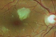 Vermehrte Schlängelung der Gefäße und Mikroinfarkt am Augenhintergrund bei einem Patienten mit erhöhtem Blutdruck
