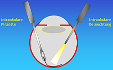 Schematische Darstellung der Entfernung einer krankhaften Membran (Makula Pucker) &uuml;ber der Stelle des sch&auml;rfsten Sehens der Netzhaut